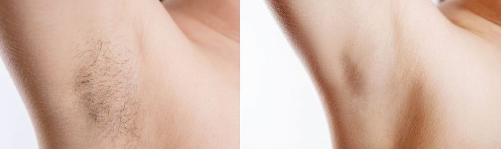 laser hair removal before and after NYC